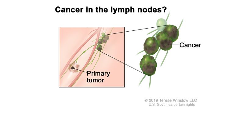 Melanoma staging (lymph node involvement); drawing shows cancer that has spread from the primary tumor to the lymph nodes.