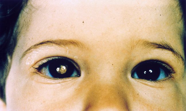 Close-up photograph showing the eyes of a child with retinoblastoma. The pupil of the eye on the left side of the photo appears white compared to the pupil of the eye on the right side of the photo.