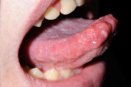 Fotografía que muestra la lengua de una persona con neoplasia endocrina múltiple de tipo 2B. La lengua está cubierta de lesiones blancas con forma irregular.