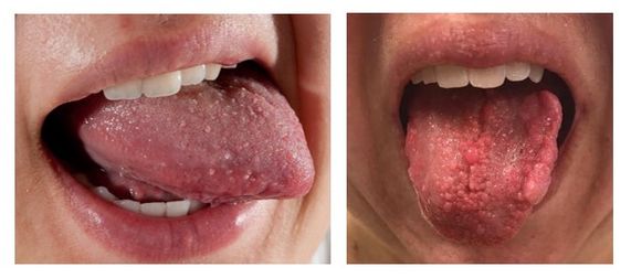 Papillomatosis of the tongue, Squamous papilloma tongue nhs