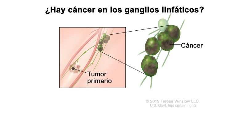 Estadificación del melanoma (compromiso de ganglios linfáticos). En el dibujo se observa un cáncer que se diseminó desde el tumor primario hasta los ganglios linfáticos.