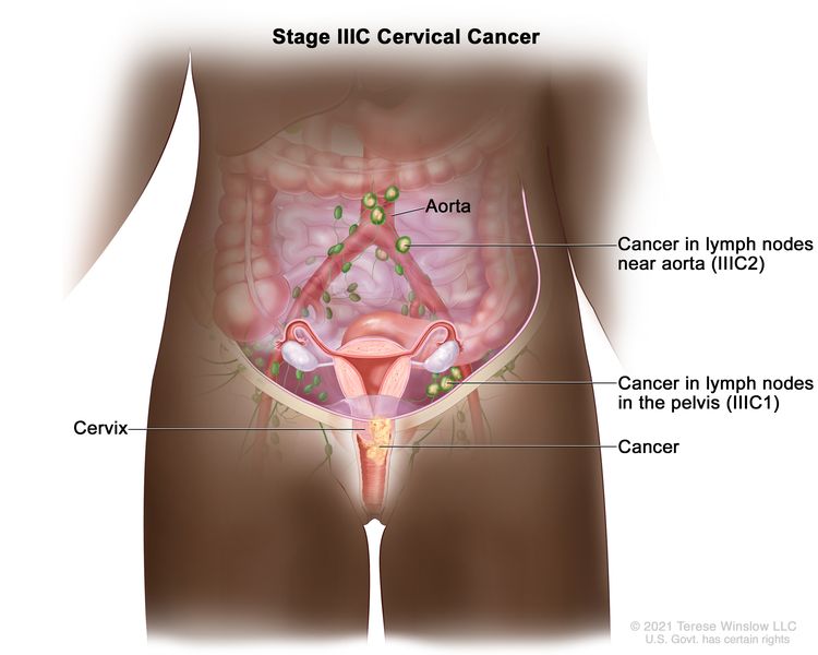 Stage IIIC cervical cancer; drawing shows stage IIIC1 cancer that has spread from the cervix to lymph nodes in the pelvis and stage IIIC2 cancer that has spread from the cervix to lymph nodes near the aorta.