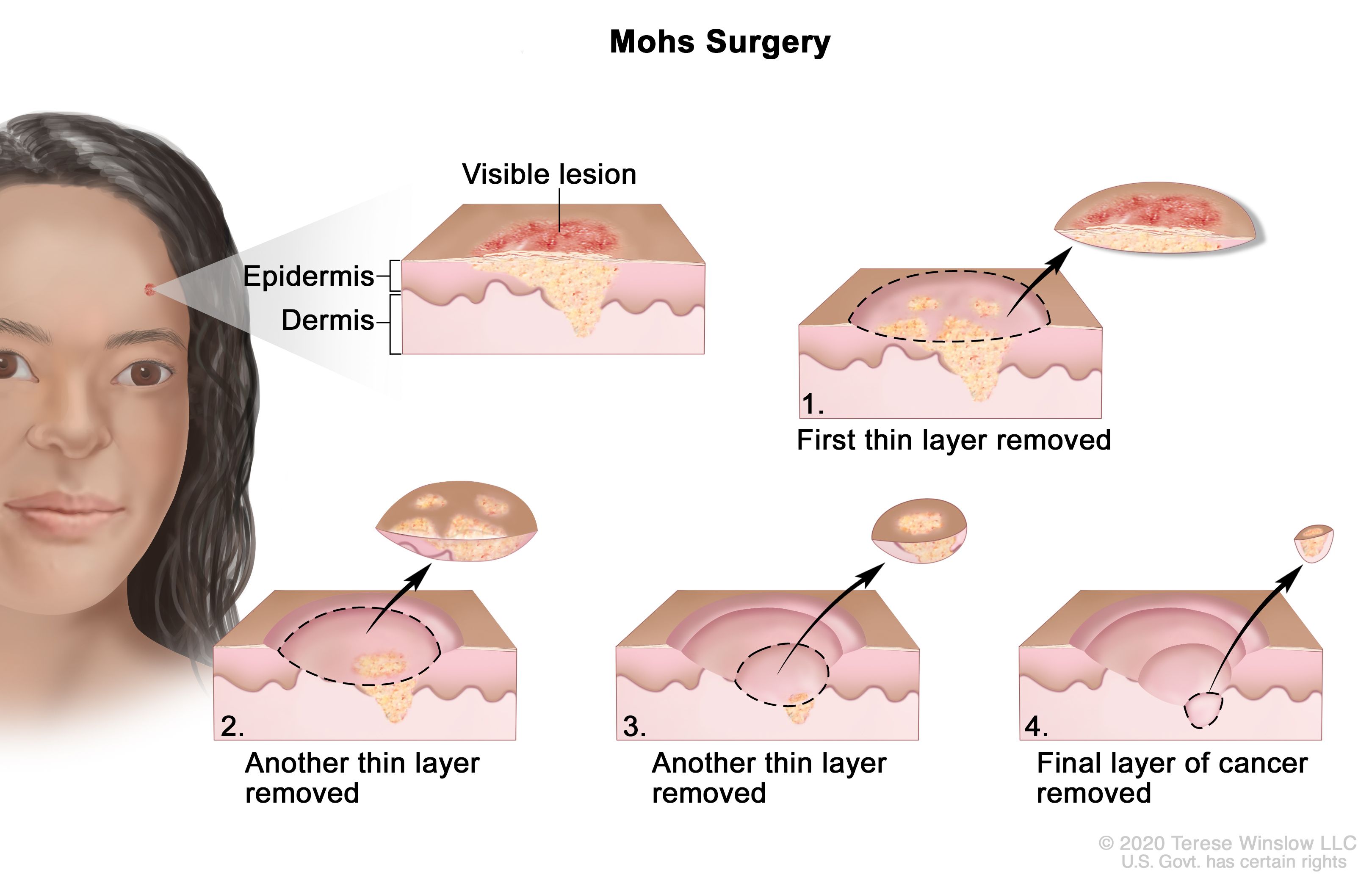 モース術：図は、顔面に皮膚がんが発生している患者さんを示す。拡大図は、表皮（皮膚の外層）と真皮（皮膚の内層）にがんが見られる皮膚の一領域を示す。皮膚の表面には、目に見える病変が示されている。番号が振られた4枚の図は、がんを全て除去するまで、皮膚の薄層を1層ずつ除去していく様子を示している。