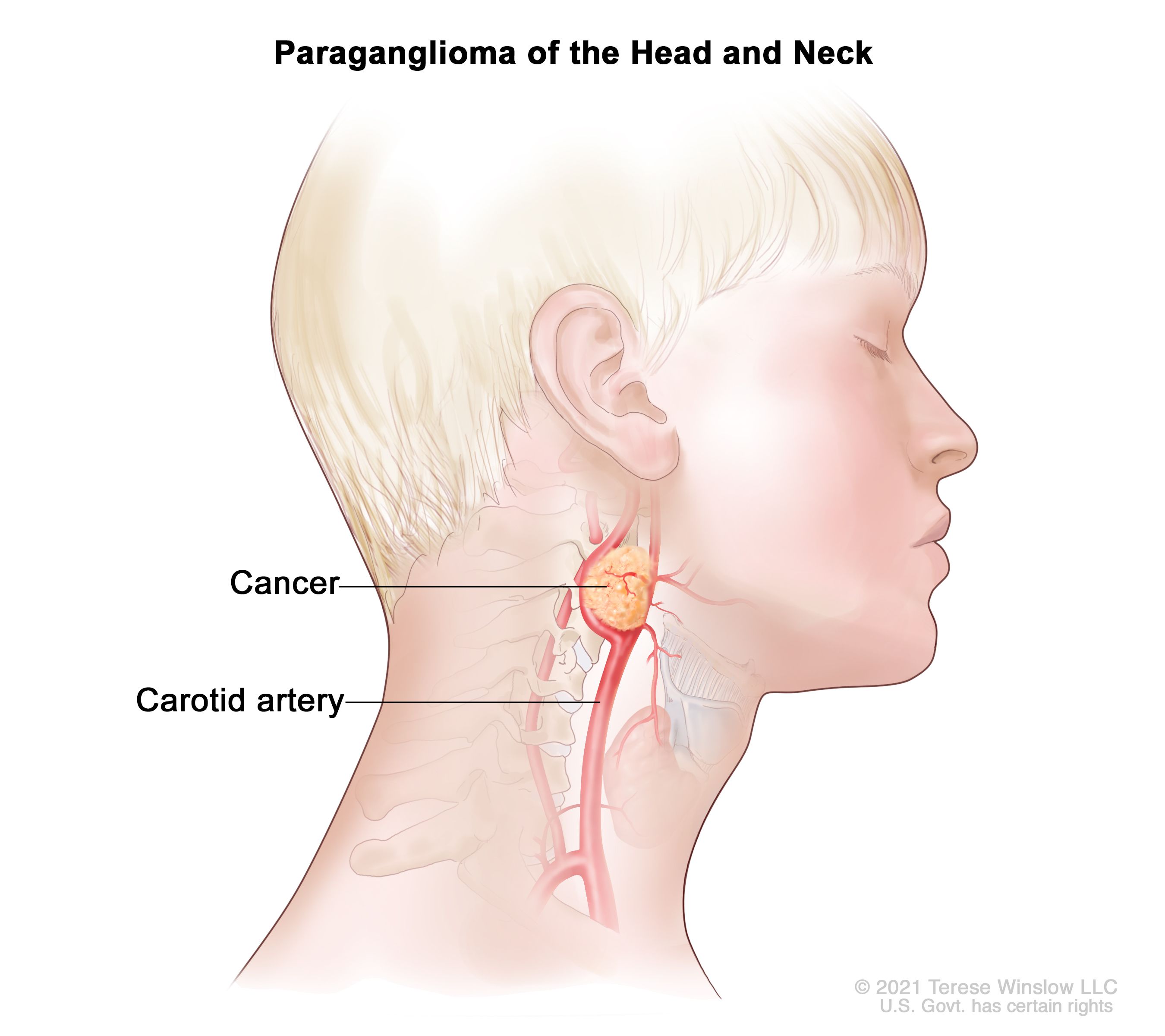 頭頸部の傍神経節腫：図は、頭頸部の頸動脈付近に生じたがん性の腫瘍を示している。