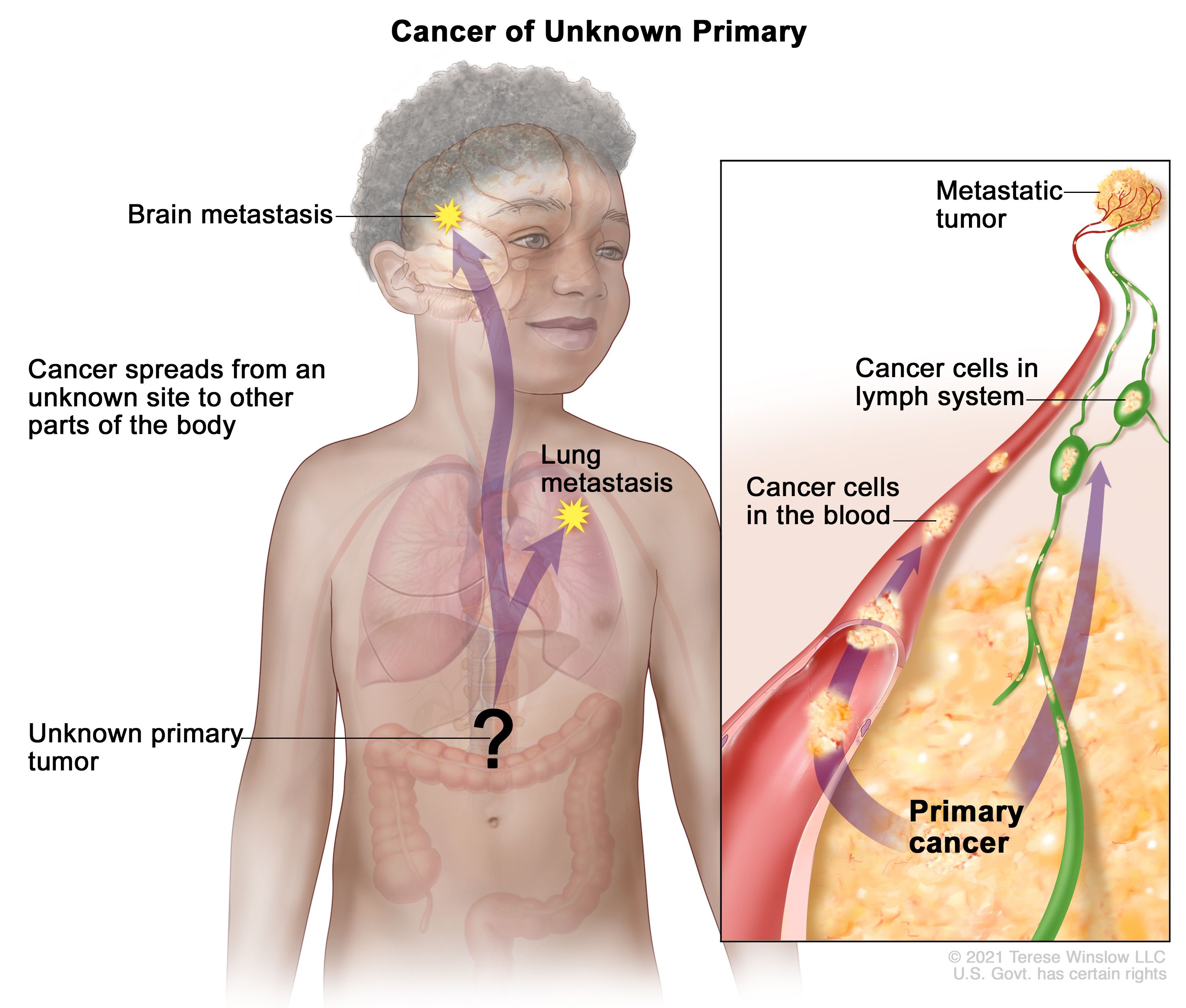 原発不明がん：図は、不明な位置から体の他の部位（肺と脳）に拡がった原発腫瘍を示している。拡大図は、原発がんが血液とリンパ系を介して体の他の部位に拡がり、転移性腫瘍を形成する様子を示している。