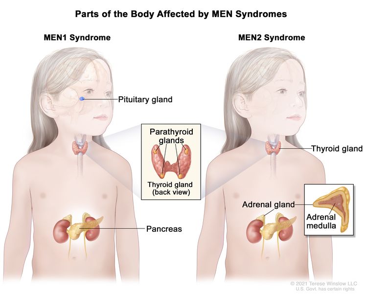 Parts of the body affected by multiple endocrine neoplasia (MEN) syndromes; the drawing on the left shows parts of the body affected by MEN1 syndrome, including the pituitary gland, parathyroid glands, and pancreas. An inset shows the back view of the thyroid gland and the four pea-sized parathyroid glands. The drawing on the right shows parts of the body affected by MEN2 syndrome, including the thyroid gland, parathyroid glands, and adrenal gland. An inset shows the adrenal medulla (inner part) of the adrenal gland.