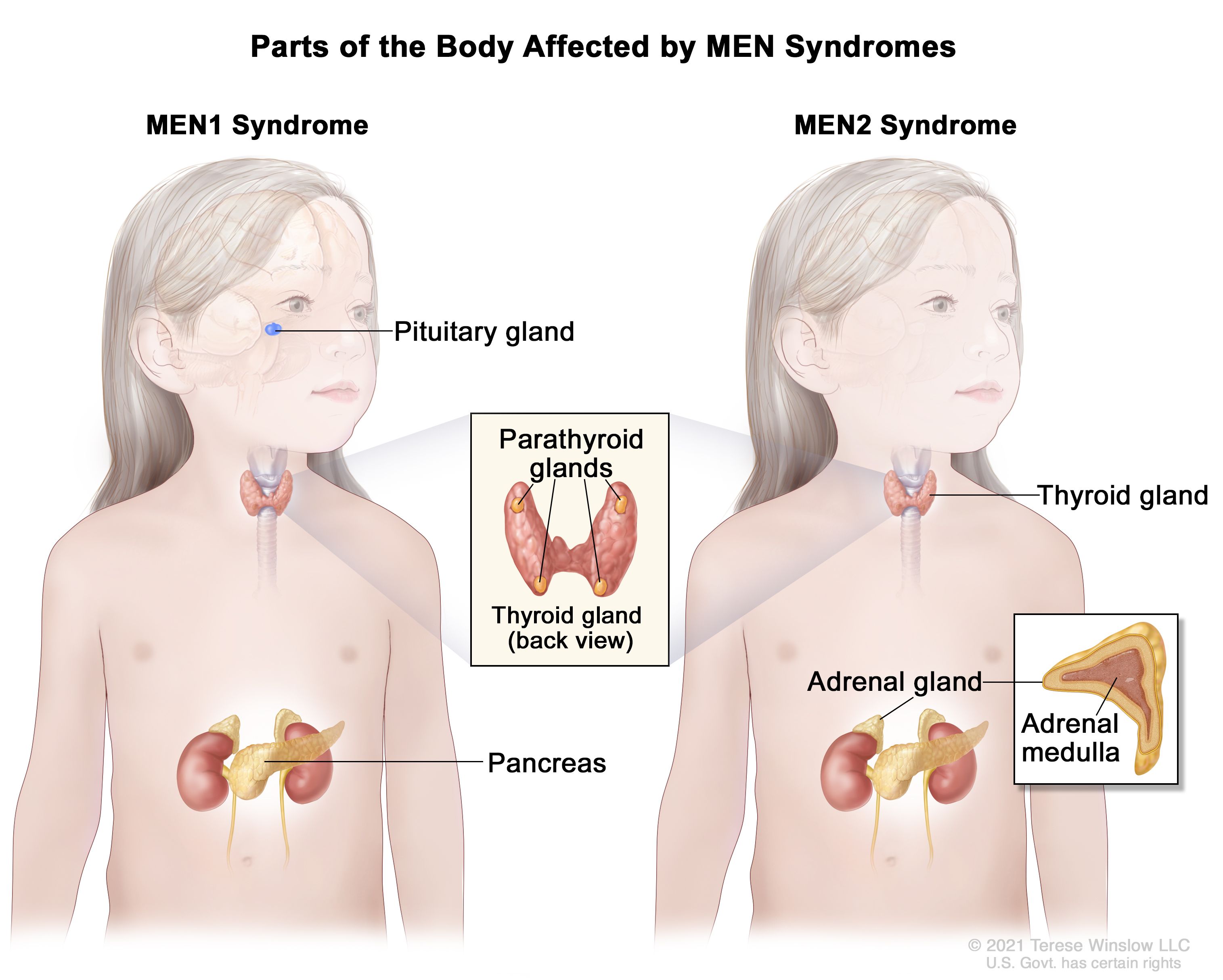 多発性内分泌腫瘍（MEN）症候群に侵される部位。左図はMEN1症候群に侵されることのある下垂体、副甲状腺、膵臓を示している。拡大図は甲状腺の背面と4つの豆粒大の副甲状腺を示している。右図は、MEN2症候群に侵されることのある甲状腺、副甲状腺、副腎を示している。拡大図は副腎髄質（副腎内部の組織）を示している。