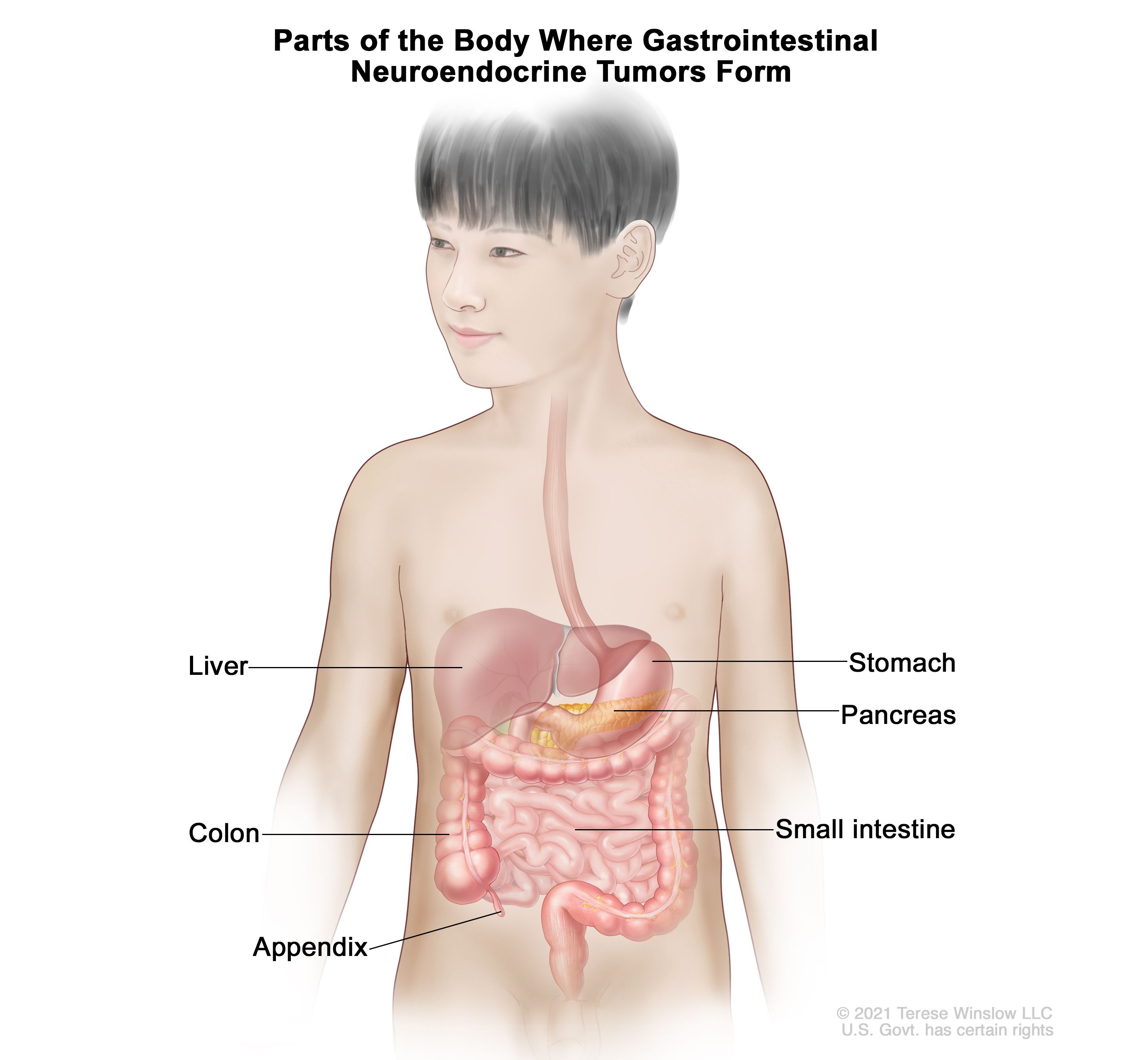 消化管カルチノイドが形成される身体部位：消化管の図に、肝臓、胃、膵臓、小腸、結腸、虫垂が示されている。