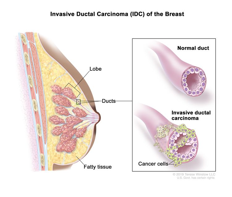 Invasive ductal carcinoma (IDC) of the breast; drawing shows a lobe, ducts, and fatty tissue in a cross section of the breast. An inset shows a normal duct and a duct with IDC and cancer cells spreading outside it.