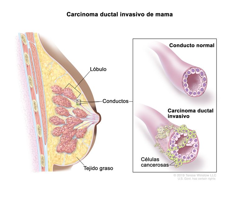 Carcinoma ductal invasivo de mama. En la imagen, se señala un lóbulo, unos conductos y el tejido graso en un corte transversal de la mama. En el recuadro, se observa un conducto normal y un conducto con carcinoma ductal invasivo donde las células cancerosas se diseminan fuera del conducto.