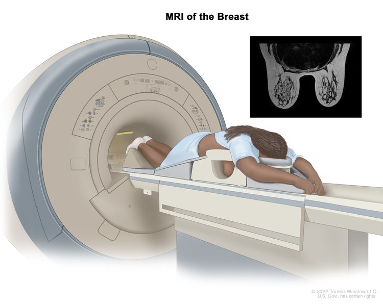 MRI of the breast; drawing shows a person lying face down on a narrow, padded table with their arms above their head. The person’s breasts hang down into an opening in the table. The table slides into the MRI machine, which takes detailed pictures of the inside of the breast. An inset shows an MRI image of the insides of both breasts.