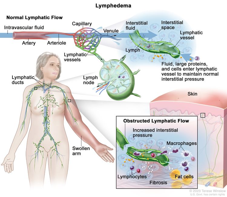 Lymphedema; the top part of the drawing shows normal lymphatic flow. An arrow is used to show intravascular fluid flowing through an artery, an arteriole, and a capillary bed, where the fluid leaks out into the interstitial space around the cells and then exits through the venules. Also shown is interstitial fluid, large proteins, and cells entering a lymphatic vessel to maintain normal interstitial pressure. The fluid in the lymphatic vessel is called lymph. Also shown is the inside structure of a lymph node attached to the lymphatic vessel with arrows showing how the lymph moves into and out of the lymph node. The lymphatic ducts in the neck area of a female figure are also shown. The figure’s left arm is red and swollen. There is a pull-out from the swollen arm showing a top layer of red, hardened skin and an inset box showing obstructed lymphatic flow. A damaged lymphatic vessel resulting in increased interstitial pressure and a build-up of large proteins, cellular debris, macrophages, and lymphocytes are shown. Large fat cells and fibrosis are also shown in the inset box.