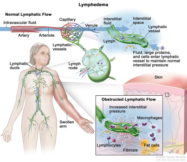 Lymphedema (PDQ®) (Health professionals)