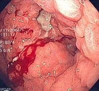 Endoscopic image of the inside of the stomach showing diffuse gastric cancer with linitis plastica involvement.