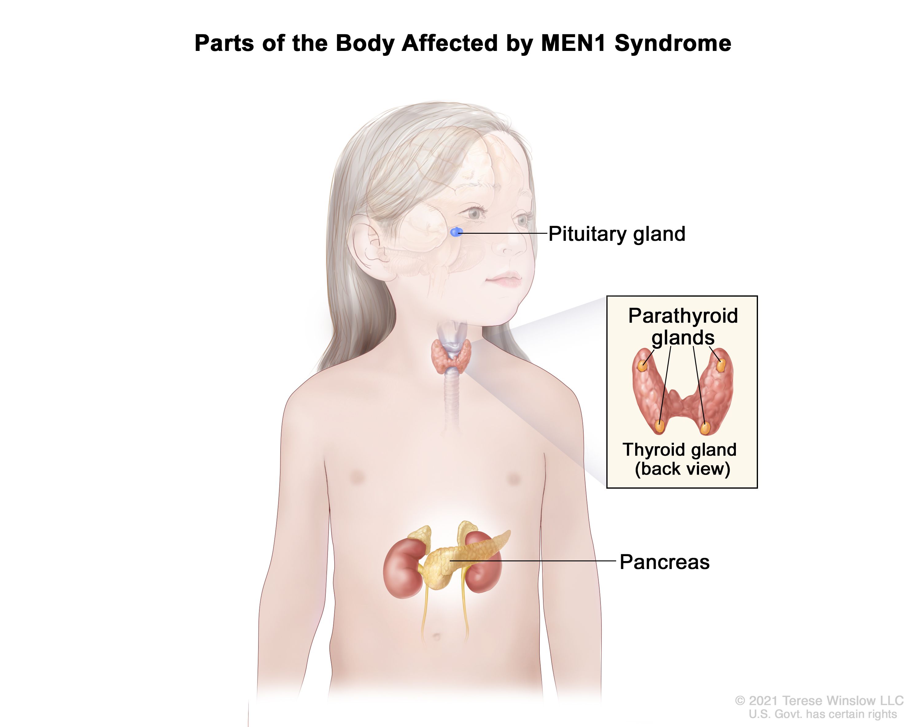 Definition of MEN1 syndrome - NCI Dictionary of Cancer Terms - NCI