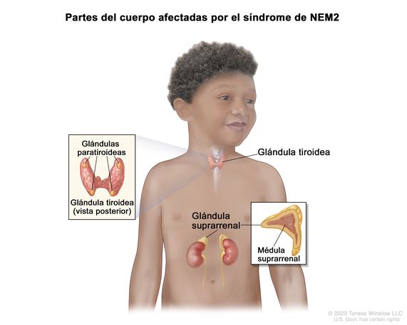 En el dibujo se observan las partes del cuerpo afectadas por el síndrome de NEM2, como las glándulas tiroidea, paratiroideas y suprarrenales. Además hay dos recuadros: en uno se muestra una vista posterior de la glándula tiroidea con las cuatro glándulas paratiroideas del tamaño de una arveja, y en el otro se muestra la parte interna de la glándula suprarrenal llamada médula suprarrenal.