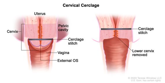 Two-panel drawing showing a cervical cerclage; the panel on the left shows the uterus and the cervix with a cerclage stitch around it. Also shown is the external OS (the opening between the cervix and vagina), the vagina, and part of the pelvic cavity. The panel on the right shows the lower part of the cervix removed and a cerclage stitch around the lower end of the uterus.