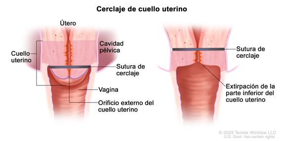 Dos dibujos que muestran un cerclaje de cuello uterino. En el dibujo de la izquierda se observa el útero y el cuello uterino con una sutura de cerclaje que lo rodea. Además, se observa el orificio externo del cuello uterino (apertura que comunica el cuello uterino con la vagina), la vagina y parte de la cavidad pélvica. En el dibujo de la derecha se muestra la extirpación de la parte inferior del cuello uterino y una sutura de cerclaje que rodea la porción inferior del útero.