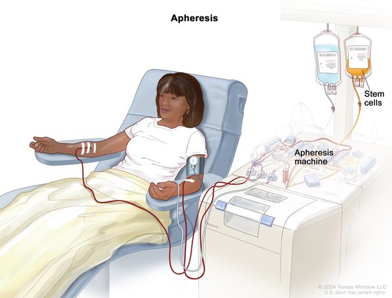 definition-of-pheresis-nci-dictionary-of-cancer-terms-nci