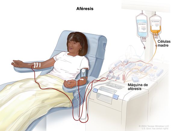 Aféresis. En el dibujo se observa una mujer sentada en una silla y en ambos brazos tiene catéteres en las venas conectados con una máquina de aféresis. Se extrae sangre del torrente sanguíneo por una vena y se hace pasar la sangre por la máquina que separa las células madre; el resto de la sangre se devuelve por la vena del otro brazo.