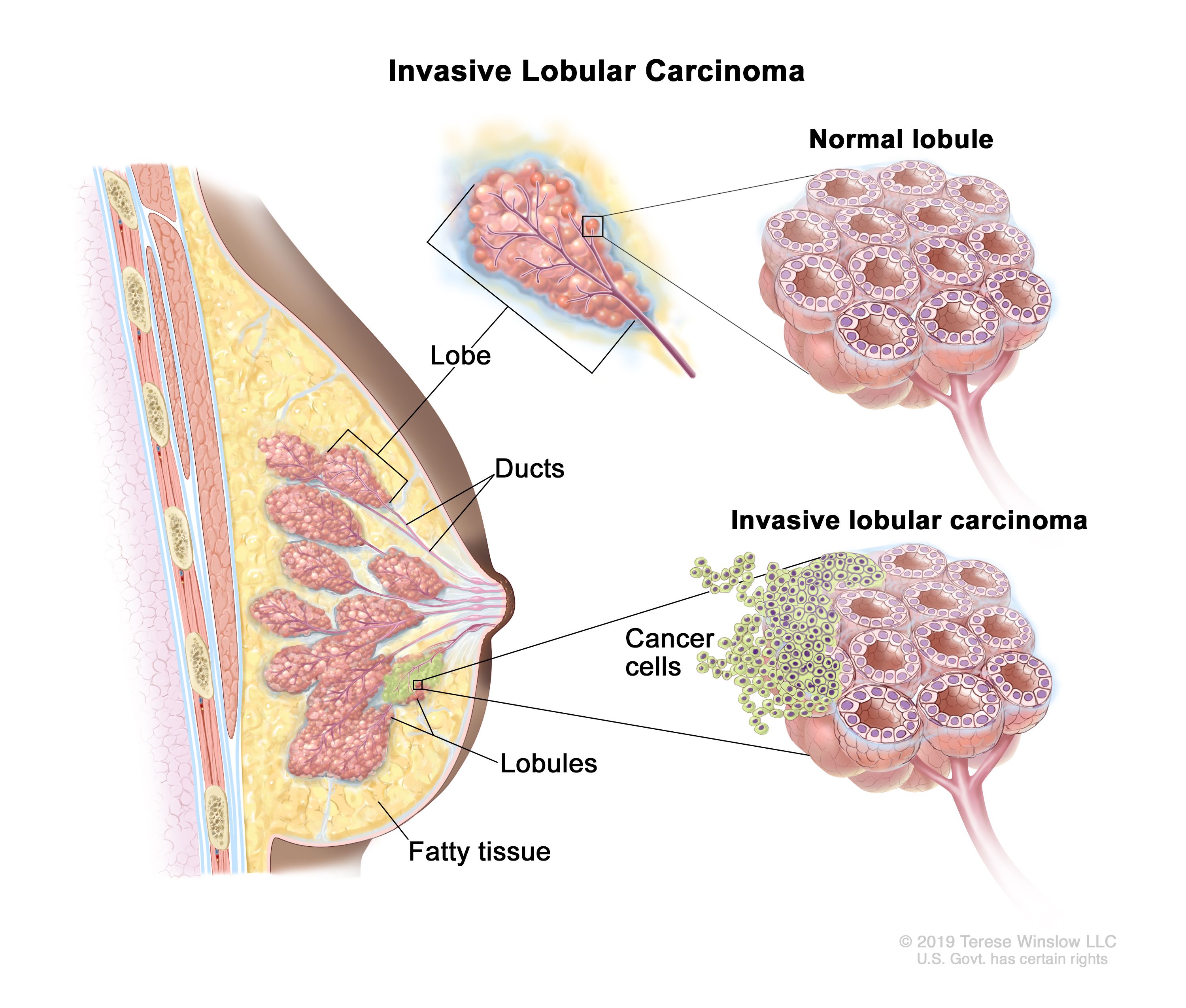 Definition of breast lobule - NCI Dictionary of Cancer Terms - NCI