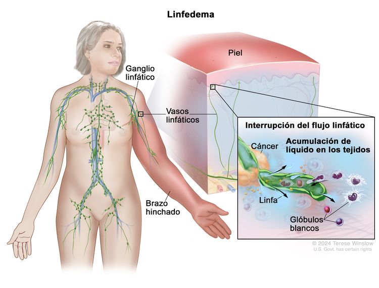 Linfedema. En el dibujo se observa una mujer con un brazo rojo e hinchado. También se señalan ganglios y vasos linfáticos en su cuerpo. Hay una ampliación del brazo hinchado en el que se observa la capa superior de la piel endurecida y roja. Además, en un recuadro se ve un vaso linfático debajo de la piel y un tumor canceroso que interrumpe el flujo de la linfa por el vaso, así como una acumulación de líquido y glóbulos blancos en los tejidos que rodean el vaso.