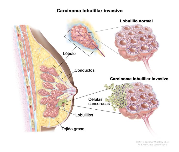 Carcinoma lobulillar invasivo de mama. En el dibujo se observa un corte transversal de una mama o seno en donde se señalan un lóbulo, lobulillos, conductos y tejido graso o adiposo. También se observan tres ampliaciones: una de un lóbulo normal, otra de un lobulillo normal y otra de un lobulillo con un carcinoma lobulillar invasivo formado por células cancerosas que se diseminan fuera de este.