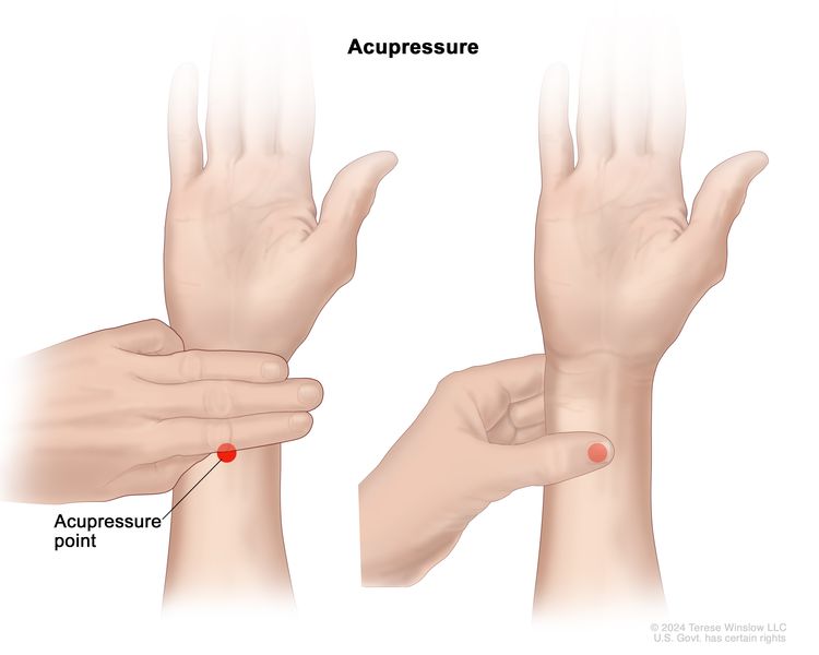 Acupressure; drawing showing the location of an acupressure point on the wrist and how to find it. The drawing on the left shows a person's arm with the palm of their hand facing up. The first three fingers of the person's other hand are placed just below the palm. There is also an acupressure point (shown as a red, circular dot) on the inner part of the wrist just below the three fingers. The drawing on the right shows the person's thumb placed directly on the acupressure point. Firm pressure is applied in a circular motion to this point.