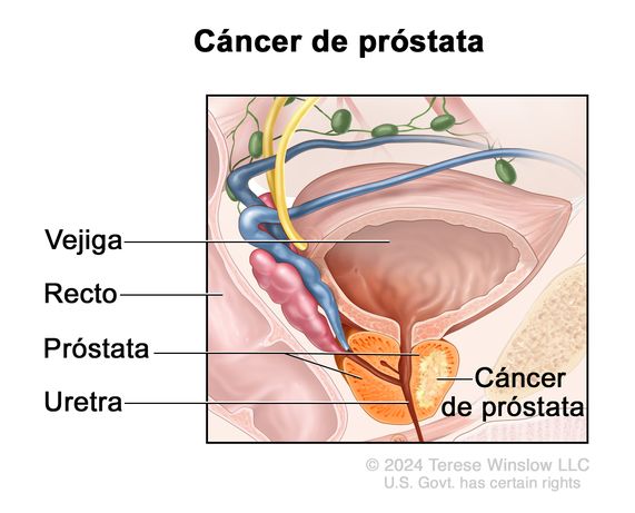 Cáncer de próstata. En el dibujo se observa cáncer en un lado de la próstata. También se señalan la vejiga, el recto y la uretra.
