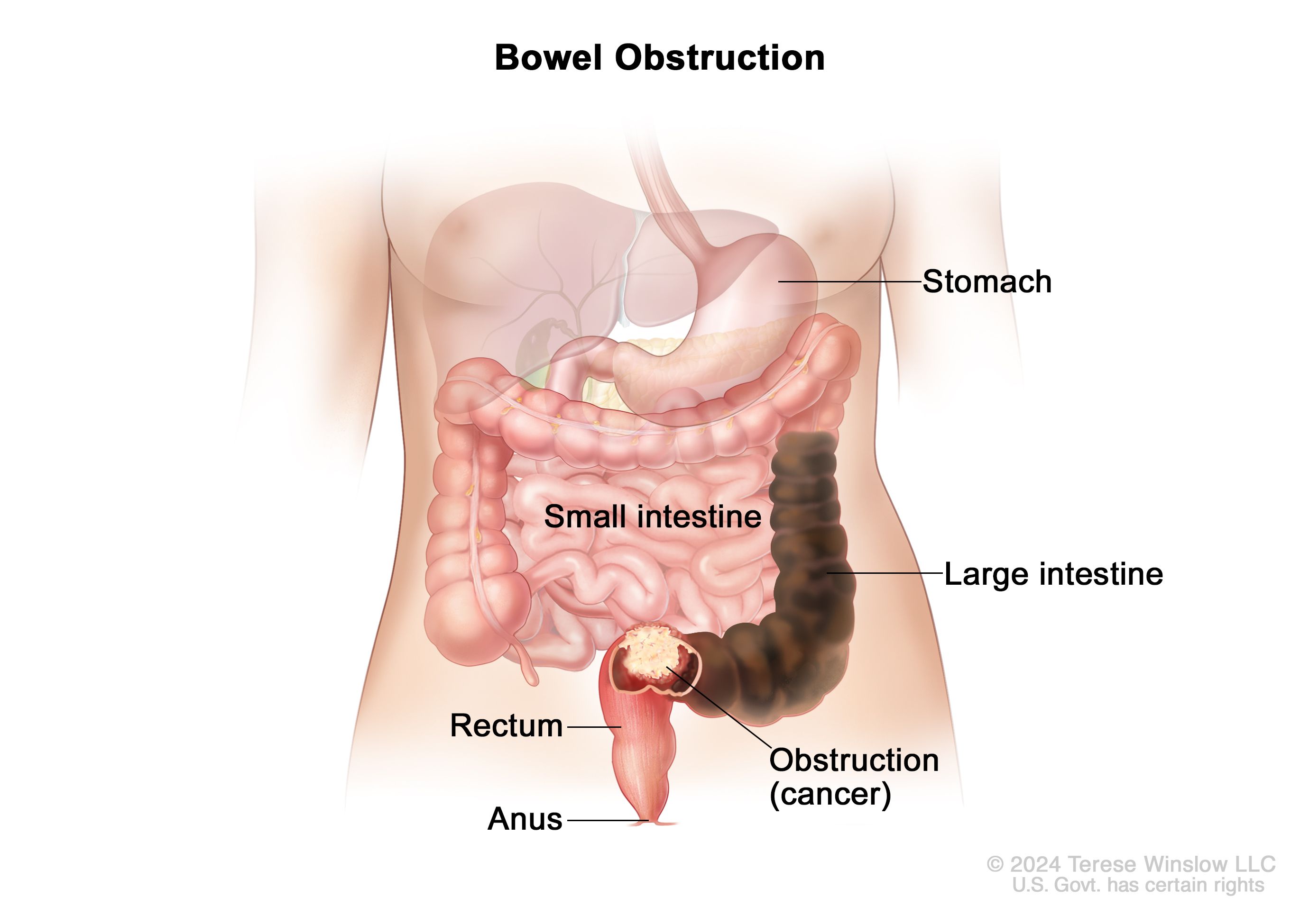 Definition Of Bowel Obstruction Nci Dictionary Of Cancer Terms Nci