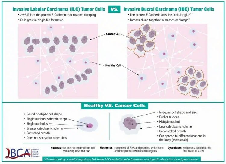 En el gráfico se observan las diferencias entre las células tumorales del carcinoma lobulillar invasivo y las células tumorales del carcinoma ductal invasivo.