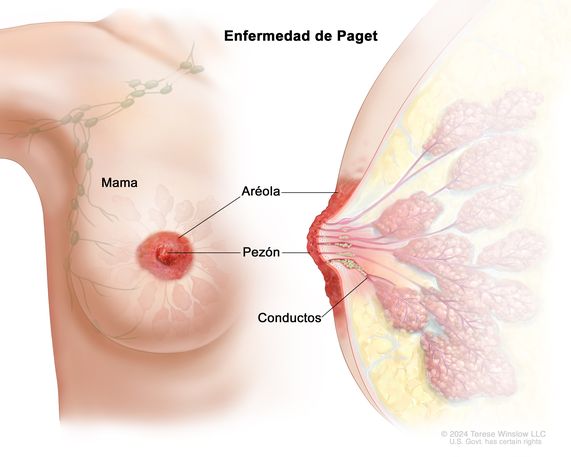 Enfermedad de Paget de la mama. En el dibujo se muestra una vista frontal de la mama donde el pezón y la aréola están enrojecidos y con costras. También se muestra una vista lateral de la mama con células cancerosas en los conductos mamarios.