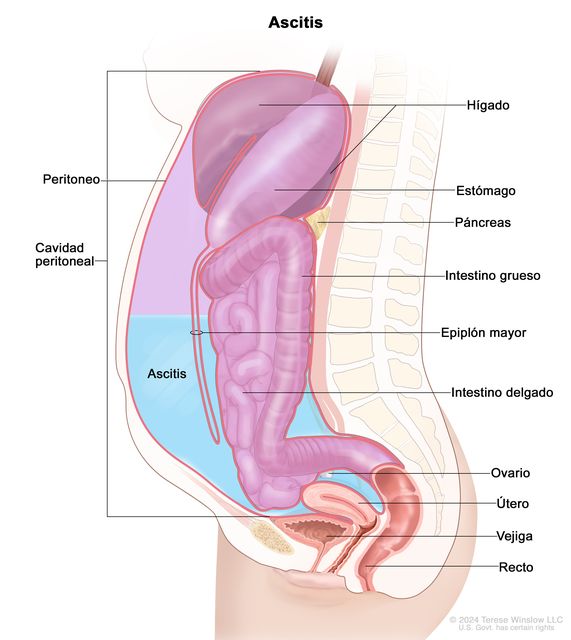 En el dibujo se observa un corte transversal de la cavidad peritoneal con ascitis. Se señalan el peritoneo, el hígado, el estómago, el páncreas, el intestino grueso, el epiplón mayor, el intestino delgado, un ovario, el útero, la vejiga y el recto.
